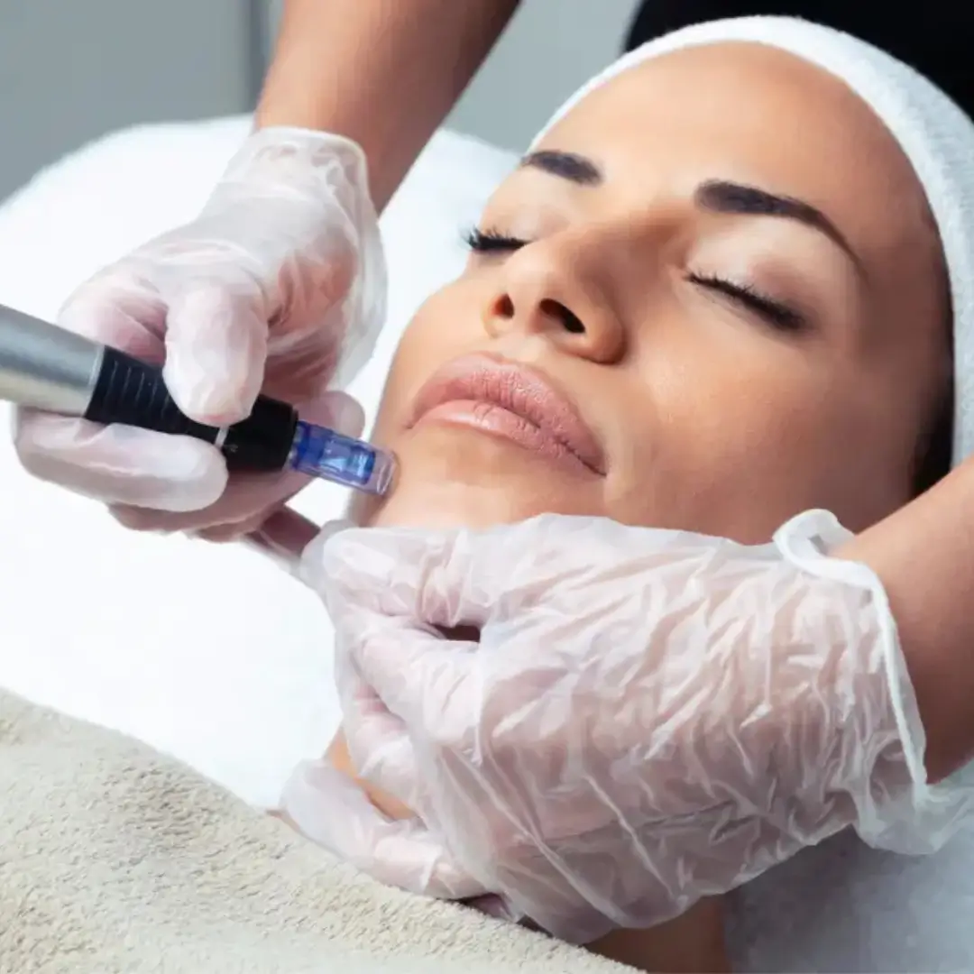 Procedura faciala EXCEED pentru microneedling la Kaelo Beauty Clinic Buzau